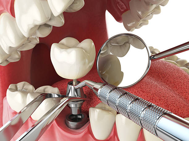 Best Cracked Tooth Emergency Dentist  in Newark, OH